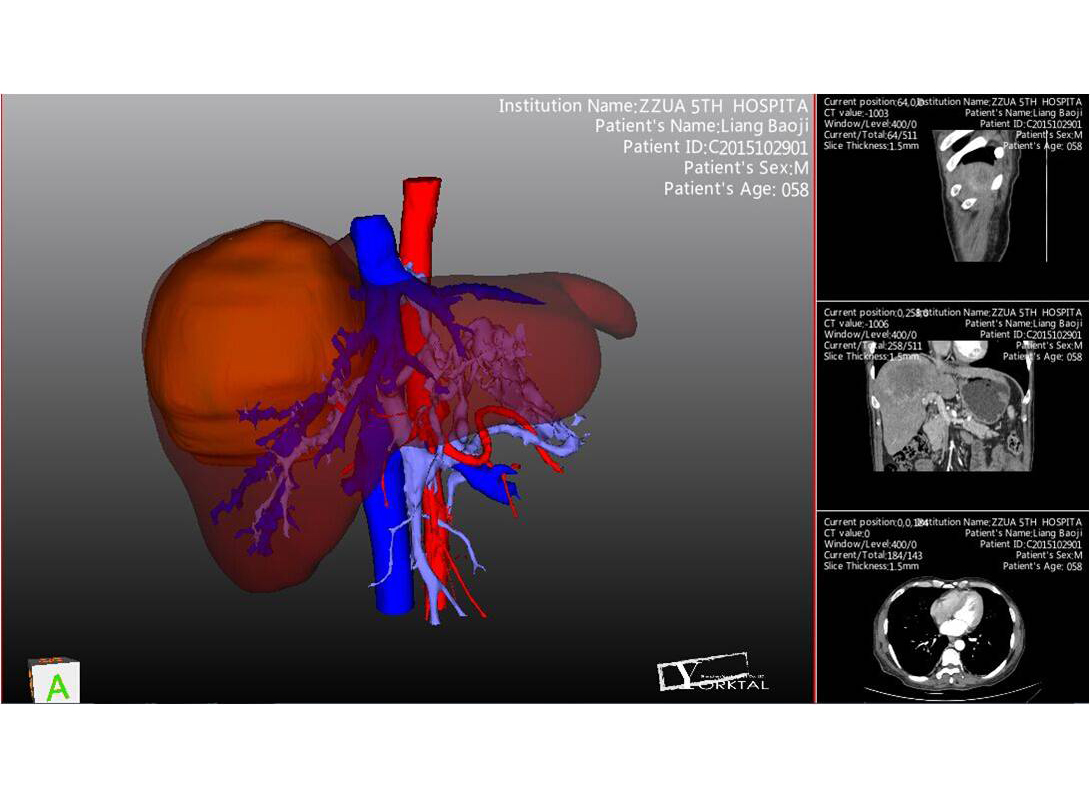 腹腔肿瘤三维重建系统（3D-Reconstruction）