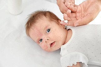 宝宝得了湿疹怎么办？