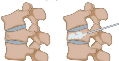 经皮穿刺椎体成形术，局麻下微创即可治疗椎体压缩骨折